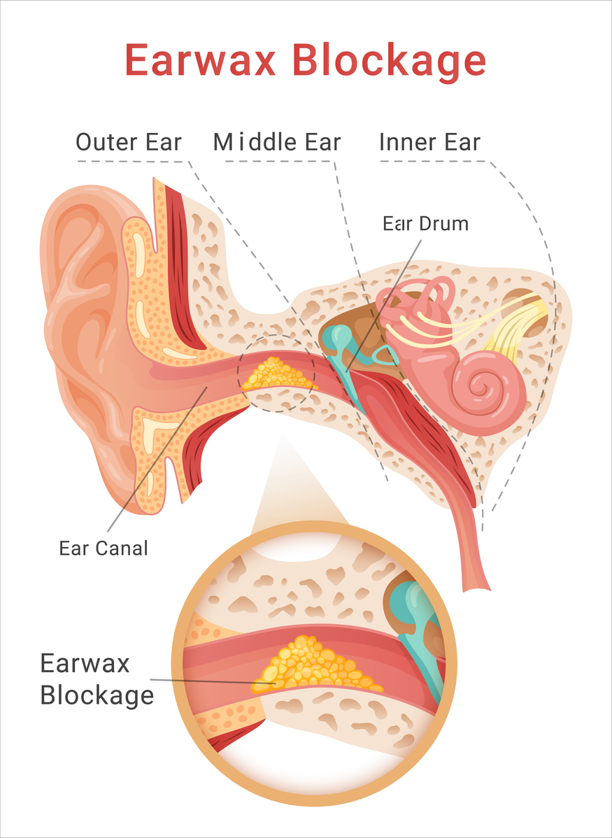 Diagram of ear wax located in the outer ear impacting hearing.